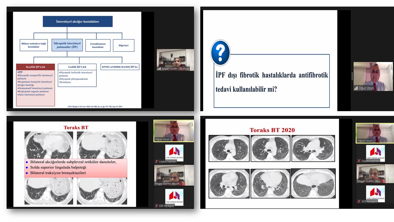 Türk Toraks Derneği Klinik Sorunlar Çalışma Grubu Mayıs Ayı Webinarı “İntersiyel Akciğer Hastalıkları ve Olgularla Yaklaşım” Başlığı ile Gerçekleştirildi