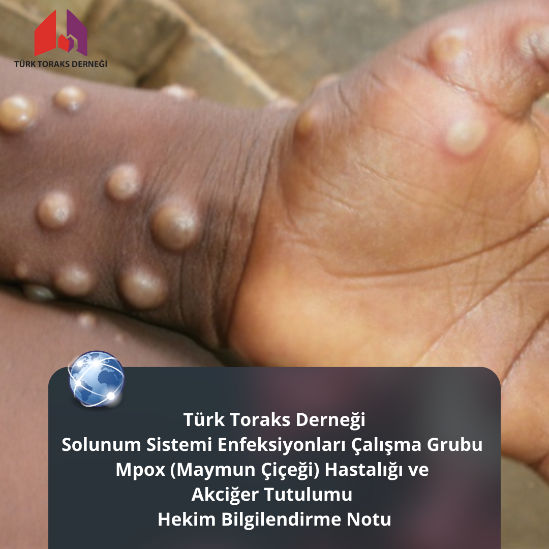 Türk Toraks Derneği Solunum Sistemi Enfeksiyonları Çalışma Grubu 