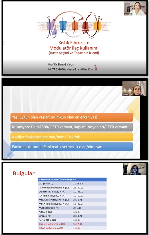 Türk Toraks Derneği Çocuk Göğüs Hastalıkları Çalışma Grubu Şubat Ayı Webinarı 